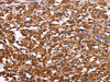 The image on the left is immunohistochemistry of paraffin-embedded Human thyroid cancer tissue using CSB-PA915948 (APMAP Antibody) at dilution 1/30, on the right is treated with synthetic peptide. (Original magnification: ×200)