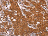 The image on the left is immunohistochemistry of paraffin-embedded Human gastric cancer tissue using CSB-PA915948 (APMAP Antibody) at dilution 1/30, on the right is treated with synthetic peptide. (Original magnification: ×200)