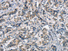 The image on the left is immunohistochemistry of paraffin-embedded Human breast cancer tissue using CSB-PA163318 (APOA1BP Antibody) at dilution 1/15, on the right is treated with synthetic peptide. (Original magnification: ×200)