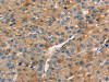 The image on the left is immunohistochemistry of paraffin-embedded Human liver cancer tissue using CSB-PA180634 (APOC4 Antibody) at dilution 1/15, on the right is treated with synthetic peptide. (Original magnification: ×200)