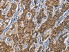 The image on the left is immunohistochemistry of paraffin-embedded Human gastic cancer tissue using CSB-PA082663 (APOL1 Antibody) at dilution 1/40, on the right is treated with synthetic peptide. (Original magnification: ×200)