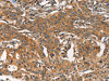 The image on the left is immunohistochemistry of paraffin-embedded Human gastric cancer tissue using CSB-PA099883 (ARPC2 Antibody) at dilution 1/30, on the right is treated with synthetic peptide. (Original magnification: ×200)