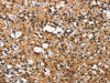 The image on the left is immunohistochemistry of paraffin-embedded Human thyroid cancer tissue using CSB-PA938467 (ITGA2 Antibody) at dilution 1/15, on the right is treated with synthetic peptide. (Original magnification: ×200)