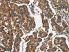 The image on the left is immunohistochemistry of paraffin-embedded Human breast cancer tissue using CSB-PA079340 (ITGA2 Antibody) at dilution 1/30, on the right is treated with synthetic peptide. (Original magnification: ×200)