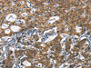 The image on the left is immunohistochemistry of paraffin-embedded Human gastic cancer tissue using CSB-PA827634 (DCC Antibody) at dilution 1/70, on the right is treated with synthetic peptide. (Original magnification: ×200)