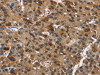 The image on the left is immunohistochemistry of paraffin-embedded Human liver cancer tissue using CSB-PA827634 (DCC Antibody) at dilution 1/70, on the right is treated with synthetic peptide. (Original magnification: ×200)