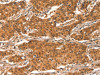 The image on the left is immunohistochemistry of paraffin-embedded Human gastic cancer tissue using CSB-PA974724 (CHUK Antibody) at dilution 1/15, on the right is treated with synthetic peptide. (Original magnification: ×200)