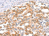 The image on the left is immunohistochemistry of paraffin-embedded Human thyroid cancer tissue using CSB-PA247753 (IKBKB Antibody) at dilution 1/25, on the right is treated with synthetic peptide. (Original magnification: ×200)