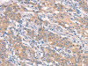 The image on the left is immunohistochemistry of paraffin-embedded Human gastric cancer tissue using CSB-PA247753 (IKBKB Antibody) at dilution 1/25, on the right is treated with synthetic peptide. (Original magnification: ×200)