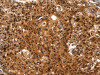 The image on the left is immunohistochemistry of paraffin-embedded Human gastic cancer tissue using CSB-PA549629 (LIN28A Antibody) at dilution 1/15, on the right is treated with synthetic peptide. (Original magnification: ×200)