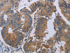 The image on the left is immunohistochemistry of paraffin-embedded Human colon cancer tissue using CSB-PA145264 (PRKD3 Antibody) at dilution 1/50, on the right is treated with synthetic peptide. (Original magnification: ×200)