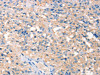 The image on the left is immunohistochemistry of paraffin-embedded Human thyroid cancer tissue using CSB-PA568434 (PRPS1/2/1L1 Antibody) at dilution 1/30, on the right is treated with synthetic peptide. (Original magnification: ×200)