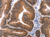 The image on the left is immunohistochemistry of paraffin-embedded Human colon cancer tissue using CSB-PA584061 (MAPK13 Antibody) at dilution 1/15, on the right is treated with synthetic peptide. (Original magnification: ×200)