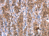 The image on the left is immunohistochemistry of paraffin-embedded Human gastric cancer tissue using CSB-PA584061 (MAPK13 Antibody) at dilution 1/15, on the right is treated with synthetic peptide. (Original magnification: ×200)