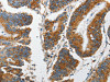 The image on the left is immunohistochemistry of paraffin-embedded Human colon cancer tissue using CSB-PA267095 (MARK2 Antibody) at dilution 1/15, on the right is treated with synthetic peptide. (Original magnification: ×200)
