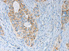 The image on the left is immunohistochemistry of paraffin-embedded Human cervical cancer tissue using CSB-PA267095 (MARK2 Antibody) at dilution 1/15, on the right is treated with synthetic peptide. (Original magnification: ×200)