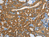 The image on the left is immunohistochemistry of paraffin-embedded Human thyroid cancer tissue using CSB-PA637350 (EPHB3 Antibody) at dilution 1/40, on the right is treated with synthetic peptide. (Original magnification: ×200)