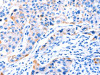 The image on the left is immunohistochemistry of paraffin-embedded Human lung cancer tissue using CSB-PA290049 (SMG8 Antibody) at dilution 1/50, on the right is treated with synthetic peptide. (Original magnification: ×200)