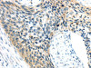 The image on the left is immunohistochemistry of paraffin-embedded Human esophagus cancer tissue using CSB-PA225304 (AEBP1 Antibody) at dilution 1/25, on the right is treated with synthetic peptide. (Original magnification: ×200)