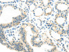 The image on the left is immunohistochemistry of paraffin-embedded Human thyroid cancer tissue using CSB-PA225304 (AEBP1 Antibody) at dilution 1/25, on the right is treated with synthetic peptide. (Original magnification: ×200)