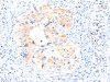 The image on the left is immunohistochemistry of paraffin-embedded Human cervical cancer tissue using CSB-PA904906 (AIMP2 Antibody) at dilution 1/25, on the right is treated with synthetic peptide. (Original magnification: ×200)