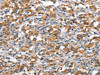 The image on the left is immunohistochemistry of paraffin-embedded Human thyroid cancer tissue using CSB-PA100422 (ANP32C Antibody) at dilution 1/15, on the right is treated with synthetic peptide. (Original magnification: ×200)