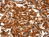 The image on the left is immunohistochemistry of paraffin-embedded Human thyroid cancer tissue using CSB-PA952743 (BCAS3 Antibody) at dilution 1/40, on the right is treated with synthetic peptide. (Original magnification: ×200)