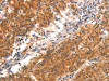 The image on the left is immunohistochemistry of paraffin-embedded Human gastic cancer tissue using CSB-PA573522 (BCL3 Antibody) at dilution 1/15, on the right is treated with synthetic peptide. (Original magnification: ×200)