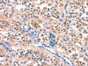 The image on the left is immunohistochemistry of paraffin-embedded Human thyroid cancer tissue using CSB-PA573522 (BCL3 Antibody) at dilution 1/15, on the right is treated with synthetic peptide. (Original magnification: ×200)