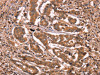 The image on the left is immunohistochemistry of paraffin-embedded Human breast cancer tissue using CSB-PA171912 (BCL6 Antibody) at dilution 1/15, on the right is treated with synthetic peptide. (Original magnification: ×200)