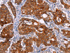 The image on the left is immunohistochemistry of paraffin-embedded Human gastic cancer tissue using CSB-PA196525 (BCR Antibody) at dilution 1/15, on the right is treated with synthetic peptide. (Original magnification: ×200)