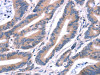 The image on the left is immunohistochemistry of paraffin-embedded Human colon cancer tissue using CSB-PA831162 (ARRB1 Antibody) at dilution 1/15, on the right is treated with synthetic peptide. (Original magnification: ×200)