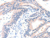 The image on the left is immunohistochemistry of paraffin-embedded Human colon cancer tissue using CSB-PA079709 (ITGA6 Antibody) at dilution 1/50, on the right is treated with synthetic peptide. (Original magnification: ×200)