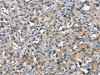 The image on the left is immunohistochemistry of paraffin-embedded Human thyroid cancer tissue using CSB-PA554127 (DDR2 Antibody) at dilution 1/40, on the right is treated with synthetic peptide. (Original magnification: ×200)