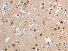The image on the left is immunohistochemistry of paraffin-embedded Human brain tissue using CSB-PA162889 (HMMR Antibody) at dilution 1/40, on the right is treated with synthetic peptide. (Original magnification: ×200)