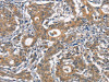 The image on the left is immunohistochemistry of paraffin-embedded Human gastic cancer tissue using CSB-PA758098 (CR2 Antibody) at dilution 1/30, on the right is treated with synthetic peptide. (Original magnification: ×200)