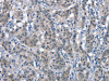 The image on the left is immunohistochemistry of paraffin-embedded Human gastric cancer tissue using CSB-PA968069 (CD226 Antibody) at dilution 1/60, on the right is treated with synthetic peptide. (Original magnification: ×200)