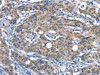 The image on the left is immunohistochemistry of paraffin-embedded Human gastric cancer tissue using CSB-PA016936 (CD226 Antibody) at dilution 1/60, on the right is treated with synthetic peptide. (Original magnification: ×200)