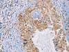 The image on the left is immunohistochemistry of paraffin-embedded Human cervical cancer tissue using CSB-PA909564 (SPAG6 Antibody) at dilution 1/30, on the right is treated with synthetic peptide. (Original magnification: ×200)