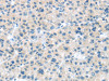 The image on the left is immunohistochemistry of paraffin-embedded Human liver cancer tissue using CSB-PA259468 (CD63 Antibody) at dilution 1/25, on the right is treated with synthetic peptide. (Original magnification: ×200)