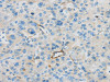 The image on the left is immunohistochemistry of paraffin-embedded Human liver cancer tissue using CSB-PA120615 (CD63 Antibody) at dilution 1/35, on the right is treated with synthetic peptide. (Original magnification: ×200)