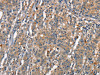 The image on the left is immunohistochemistry of paraffin-embedded Human gastic cancer tissue using CSB-PA795702 (CEACAM3 Antibody) at dilution 1/30, on the right is treated with synthetic peptide. (Original magnification: ×200)