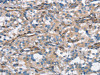 The image on the left is immunohistochemistry of paraffin-embedded Human thyroid cancer tissue using CSB-PA795702 (CEACAM3 Antibody) at dilution 1/30, on the right is treated with synthetic peptide. (Original magnification: ×200)
