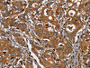 The image on the left is immunohistochemistry of paraffin-embedded Human gastic cancer tissue using CSB-PA965136 (CEACAM3 Antibody) at dilution 1/30, on the right is treated with synthetic peptide. (Original magnification: ×200)