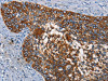 The image on the left is immunohistochemistry of paraffin-embedded Human cervical cancer tissue using CSB-PA282654 (CD68 Antibody) at dilution 1/30, on the right is treated with synthetic peptide. (Original magnification: ×200)