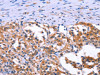 The image on the left is immunohistochemistry of paraffin-embedded Human thyroid cancer tissue using CSB-PA110575 (ANO1 Antibody) at dilution 1/40, on the right is treated with synthetic peptide. (Original magnification: ×200)