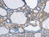 The image on the left is immunohistochemistry of paraffin-embedded Human thyroid cancer tissue using CSB-PA131838 (MUC13 Antibody) at dilution 1/30, on the right is treated with synthetic peptide. (Original magnification: ×200)