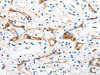 The image on the left is immunohistochemistry of paraffin-embedded Human renal cancer tissue using CSB-PA066991 (MCAM Antibody) at dilution 1/50, on the right is treated with synthetic peptide. (Original magnification: ×200)