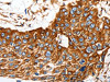 The image on the left is immunohistochemistry of paraffin-embedded Human esophagus cancer tissue using CSB-PA783399 (MCAM Antibody) at dilution 1/100, on the right is treated with synthetic peptide. (Original magnification: ×200)