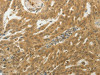 The image on the left is immunohistochemistry of paraffin-embedded Human ovarian cancer tissue using CSB-PA919414 (MYSM1 Antibody) at dilution 1/50, on the right is treated with synthetic peptide. (Original magnification: ×200)